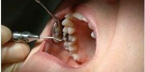 Do you still have your silver dental fillings? Maybe you removed them. Did the dentist protect himself and you when he removed these filling that contain mercury?  Exposure to mercury is very dangerous.